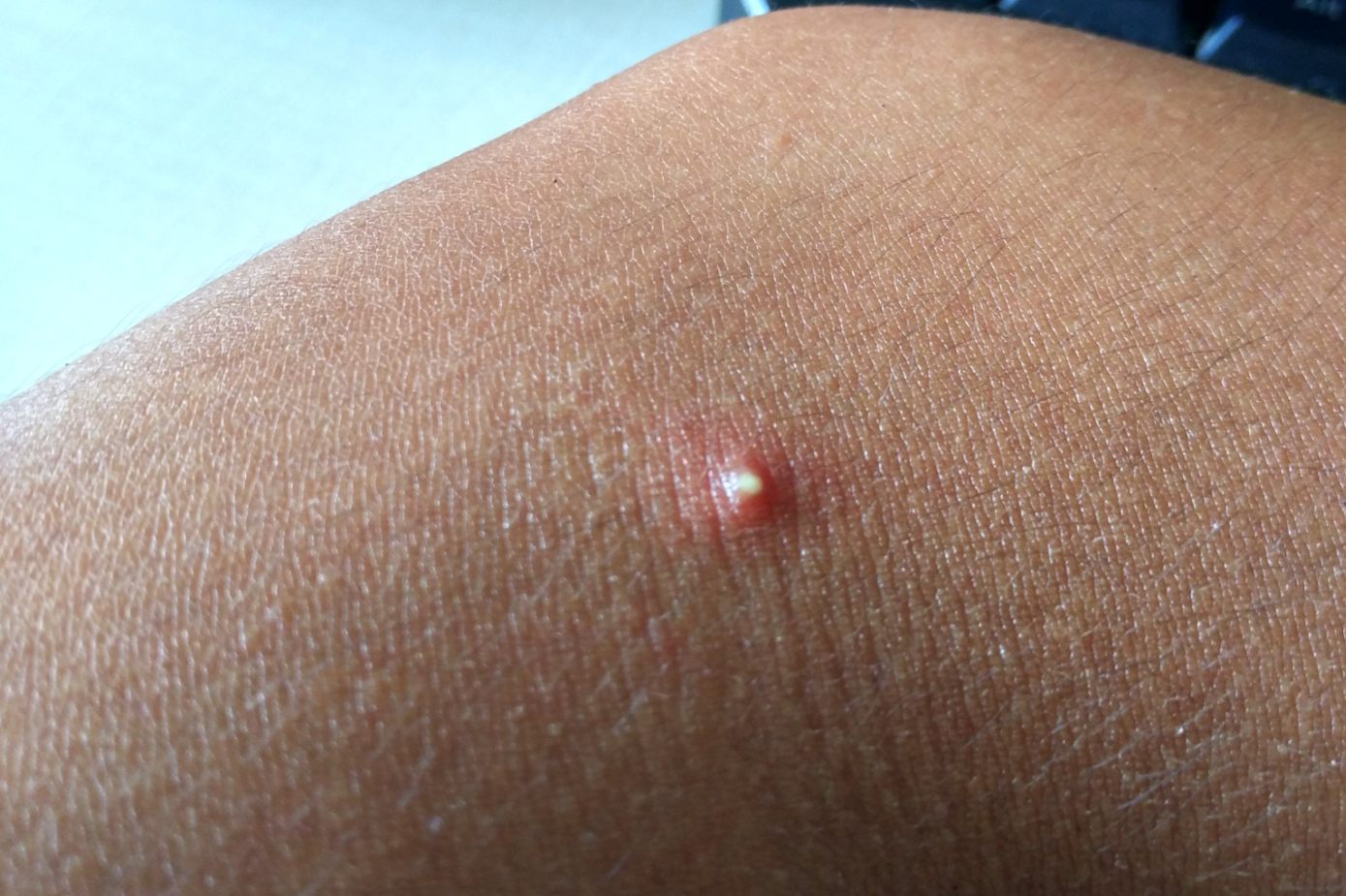 痘痘里面挤出来的白色东西是什么(痘痘到底是挤好还是不挤好)