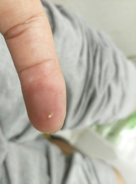 痘痘里面挤出来的白色东西是什么(痘痘到底是挤好还是不挤好)