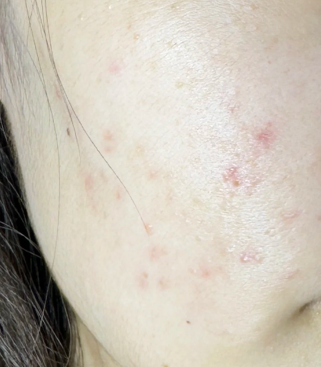 碘伏可以涂在痘痘上吗(碘伏可以擦在痘痘上消炎吗)