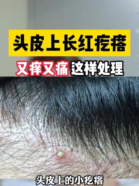 头皮长痘痘(头皮长痘痘涂什么药膏)
