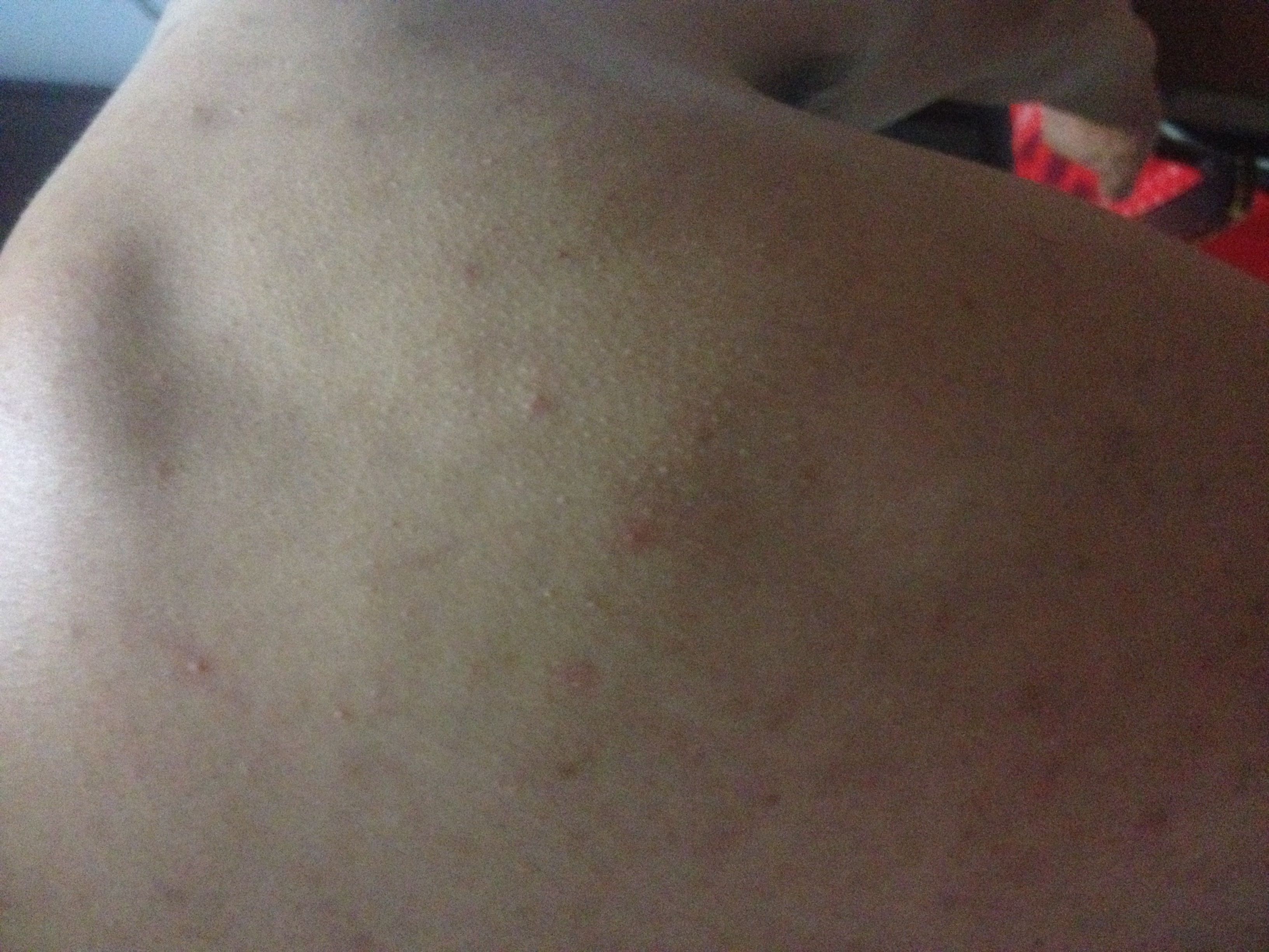 前胸后背长痘痘(前胸后背长痘痘用硫磺皂会有用吗)