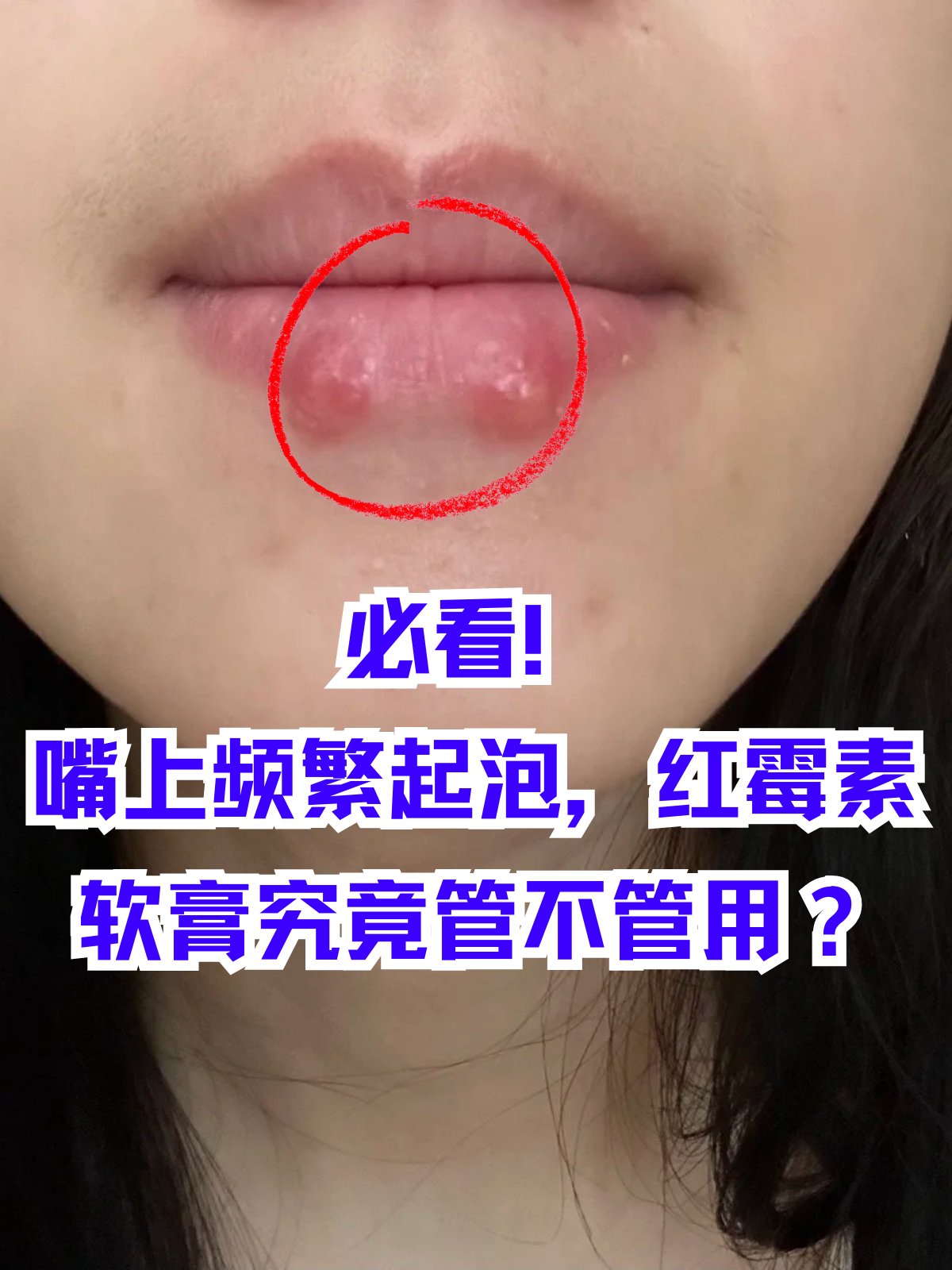 红霉素软膏可以涂痘痘吗(红霉素软膏可以涂痘痘吗有激素吗)