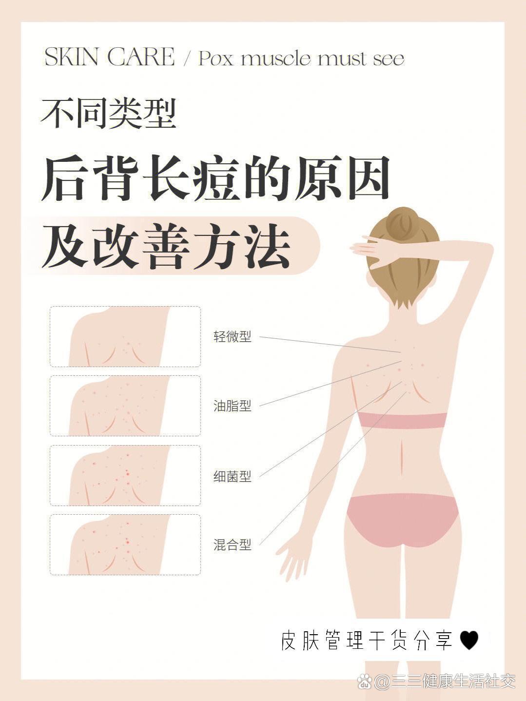 后背长痘痘的原因(后背长痘痘的原因和解决方法)