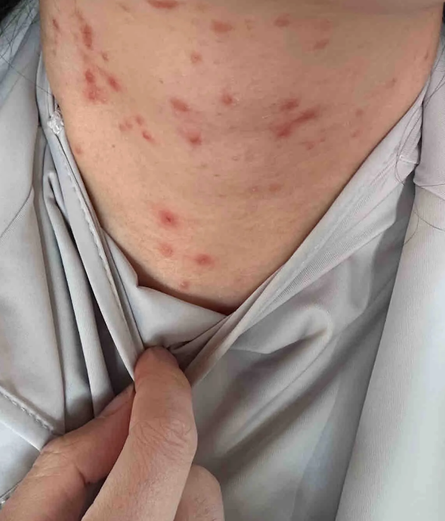 胸口长痘痘是怎么回事(背上和胸口长红色痘痘是什么原因)