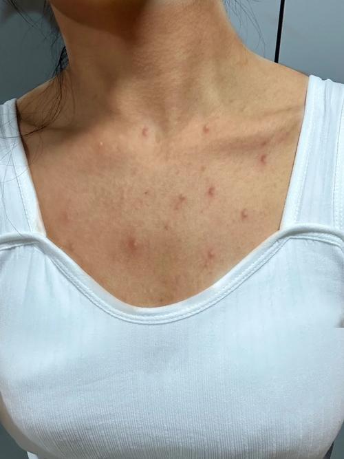 胸口长痘痘是怎么回事(背上和胸口长红色痘痘是什么原因)