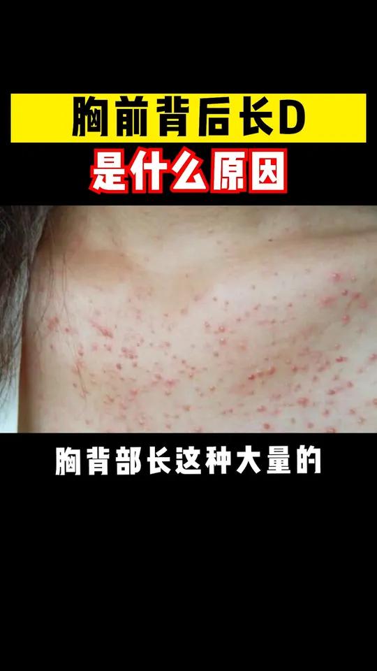 前胸后背长痘痘怎么去除(前胸后背长痘痘怎么解决)