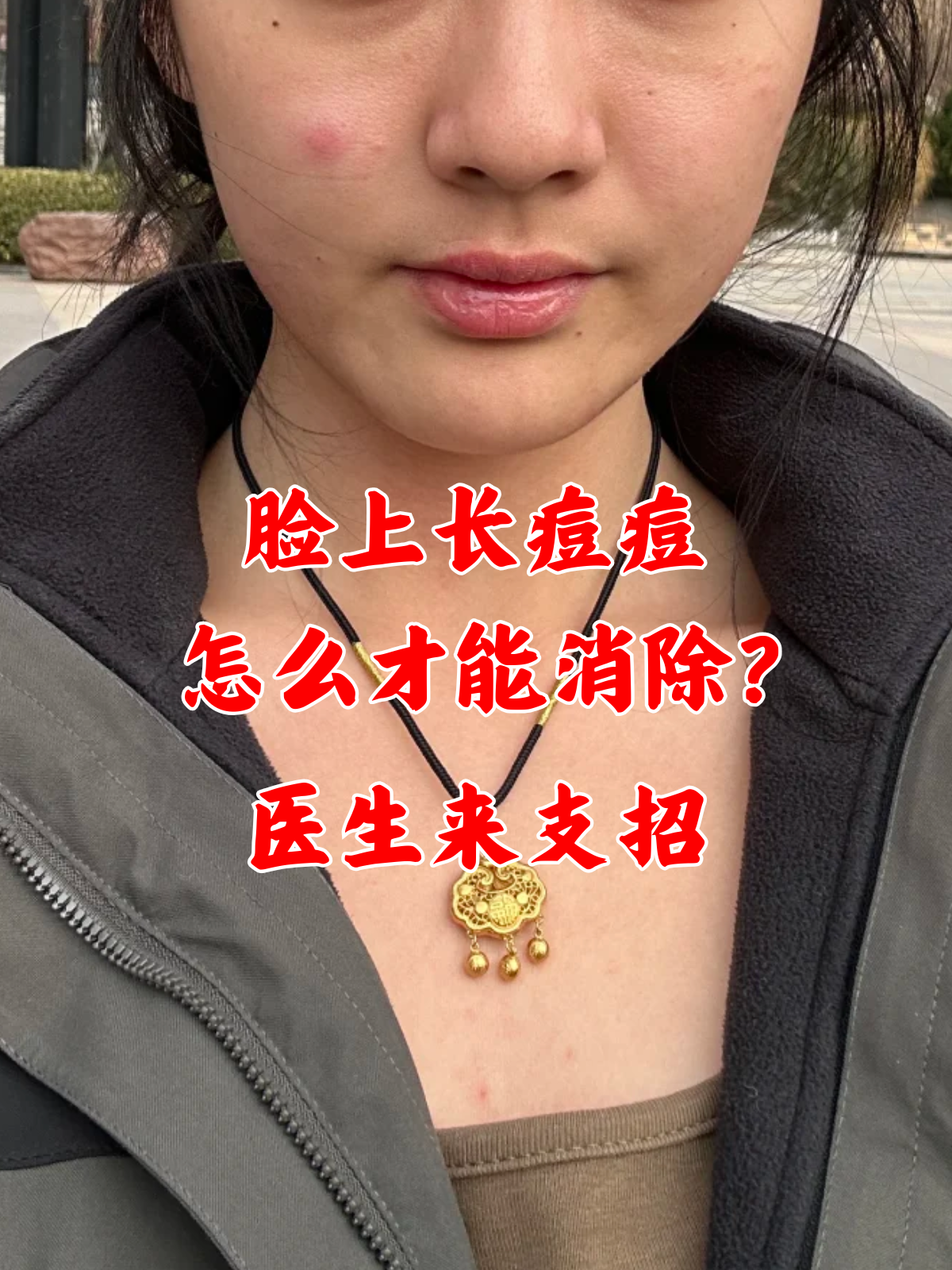 脸上长痘痘是什么原因引起的(青少年脸上长痘痘是什么原因引起的)