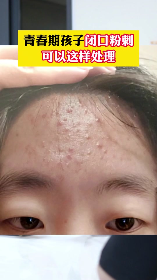 眉心长了一颗很大很硬的痘痘(眉心长痘是心火旺吗)