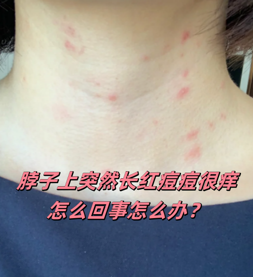 脖子上长痘痘什么原因(脖子上长痘痘什么原因长春肤康在哪)