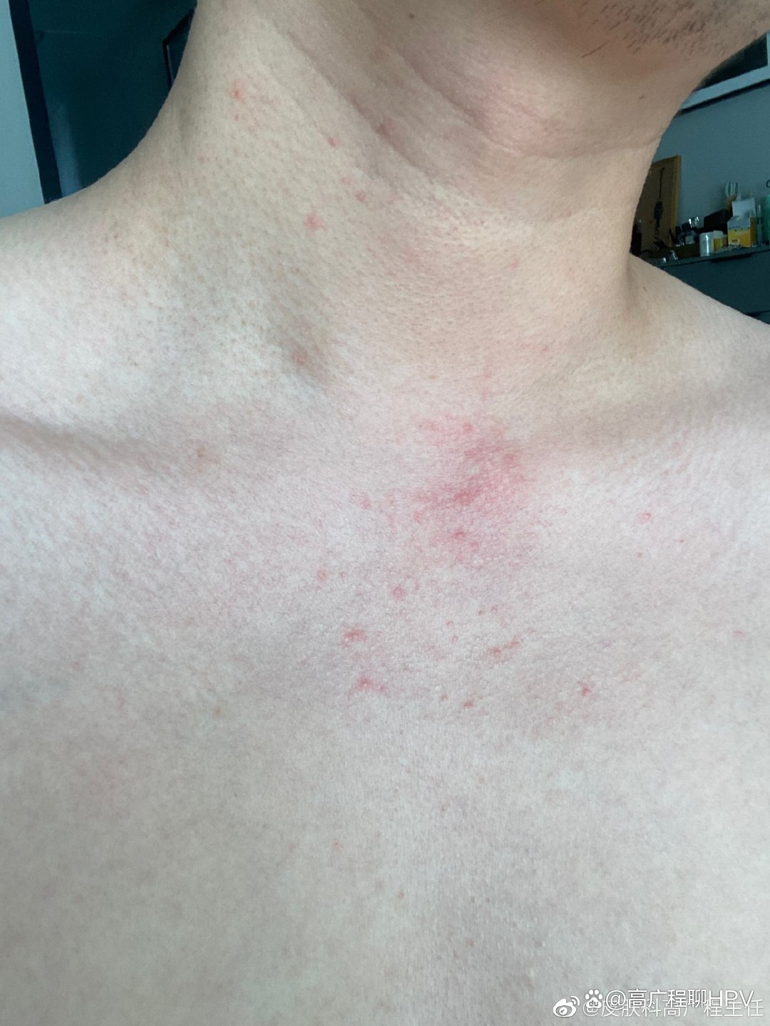 脖子上长痘痘什么原因(脖子上长痘痘什么原因长春肤康在哪)