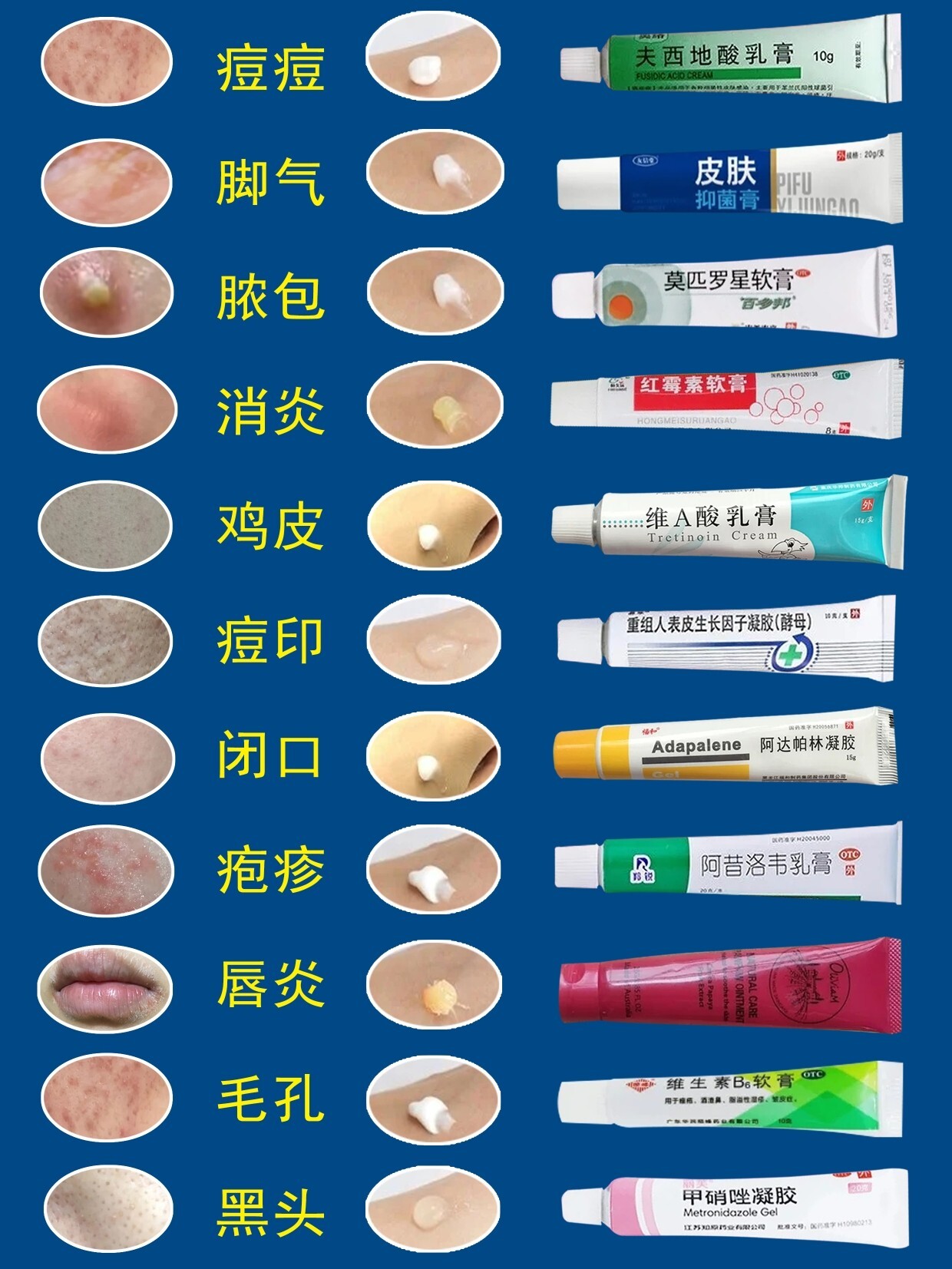 长痘痘涂什么药膏(屁股上长痘痘涂什么药膏)