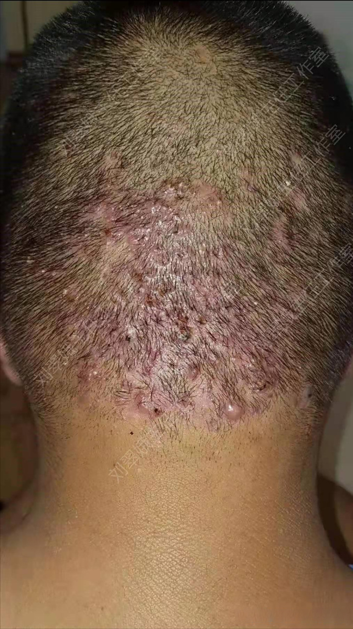 头皮上长痘痘(头皮上长痘痘和脓包用什么药膏)