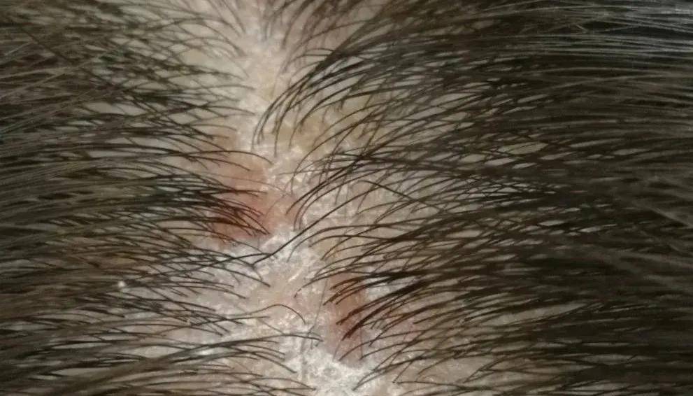 头皮上长痘痘(头皮上长痘痘和脓包用什么药膏)