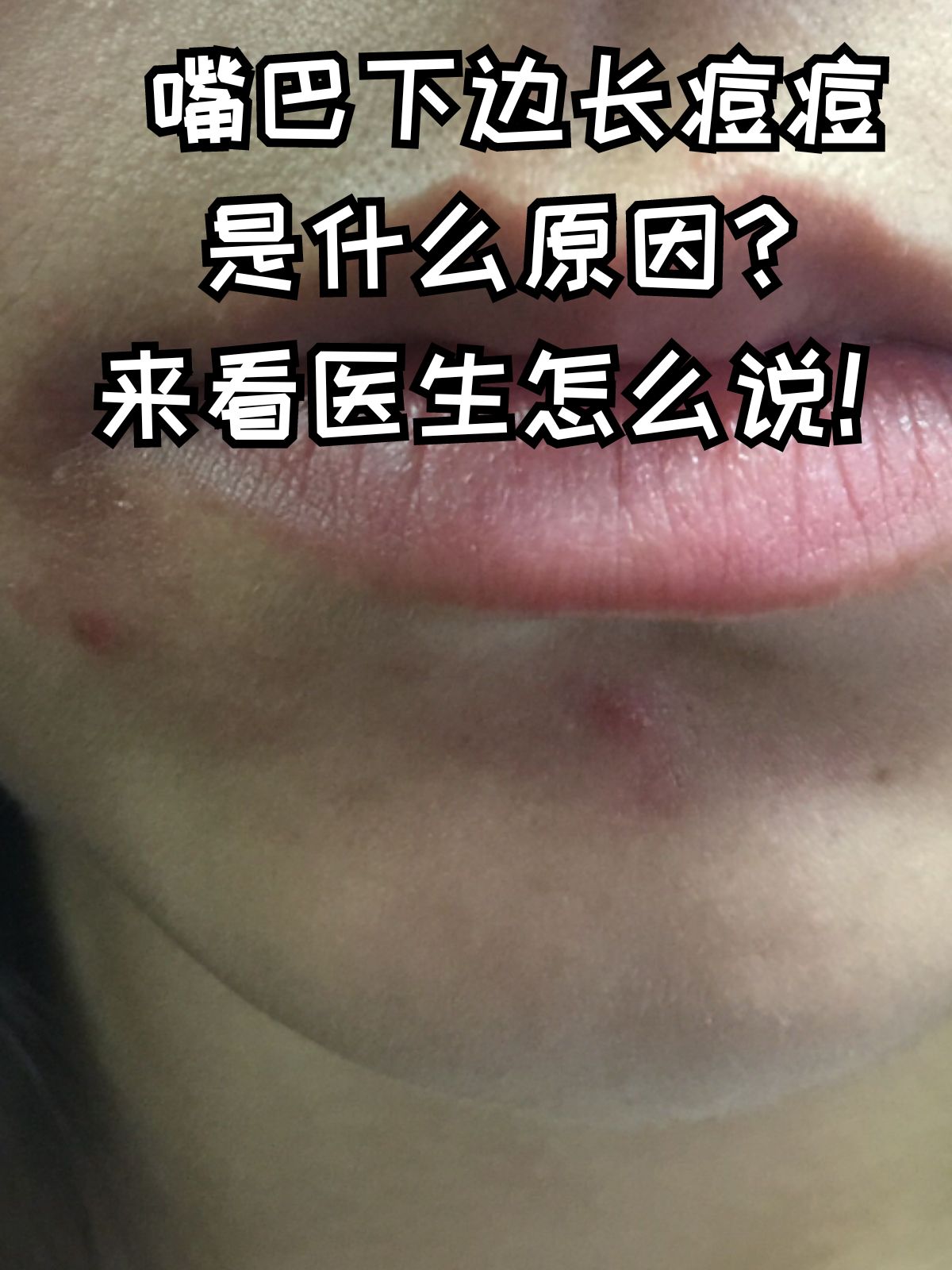 下面长痘痘是什么原因(阴道下面长痘痘是什么原因)