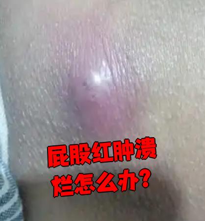 屁股长痘痘(屁股长痘痘图片的症状)