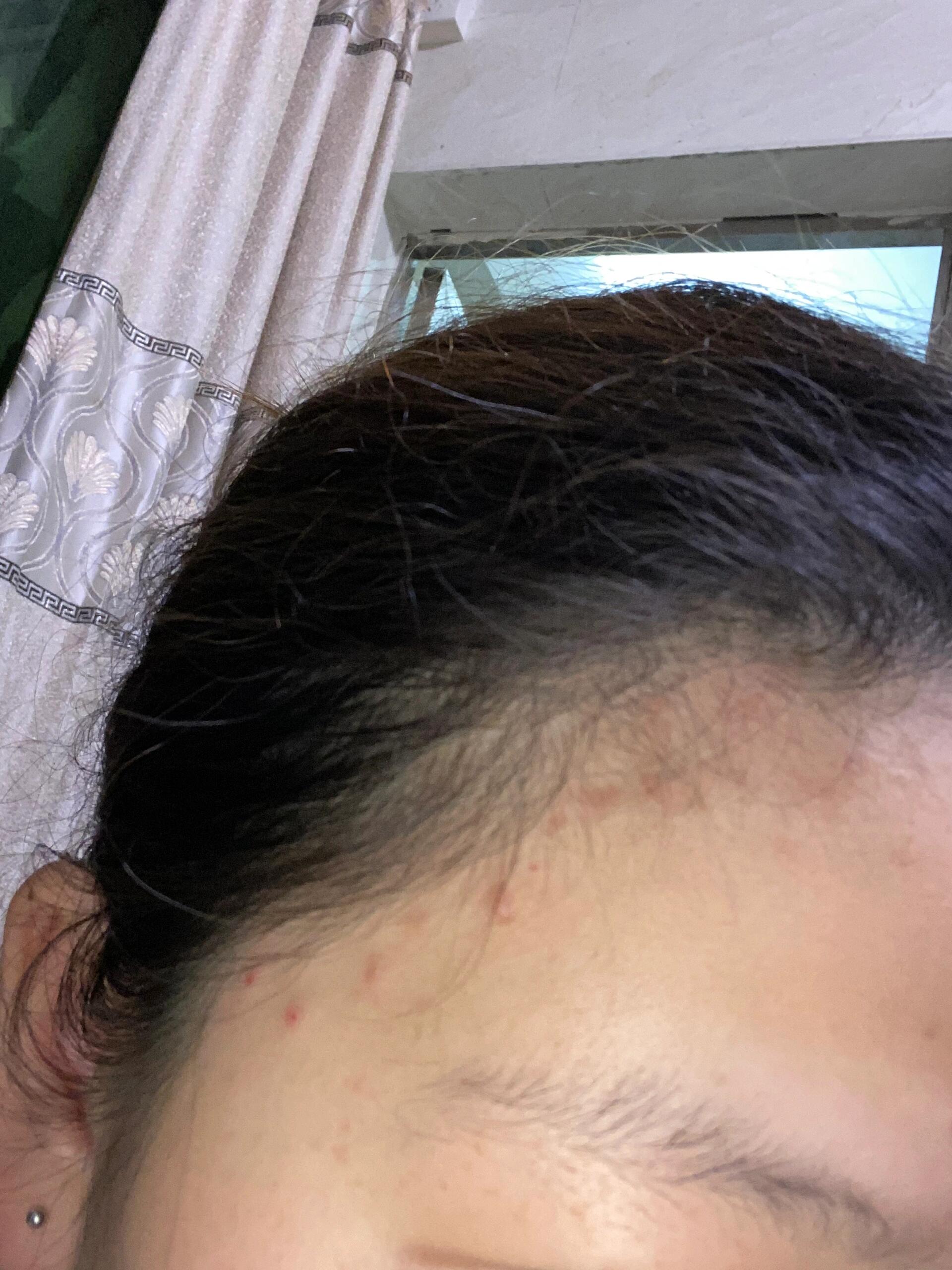 发际线长痘痘是什么原因(额头和发际线长痘痘是什么原因)