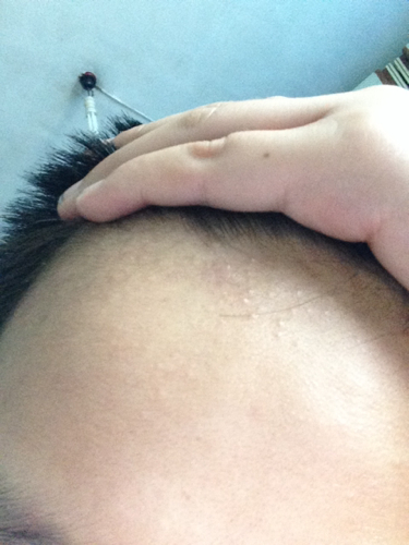 耳垂肉里长了痘痘一样的硬粒(耳垂里面长了个硬疙瘩一捏就疼)