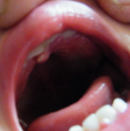 耳垂肉里长了痘痘一样的硬粒(耳垂里面长了个硬疙瘩一捏就疼)