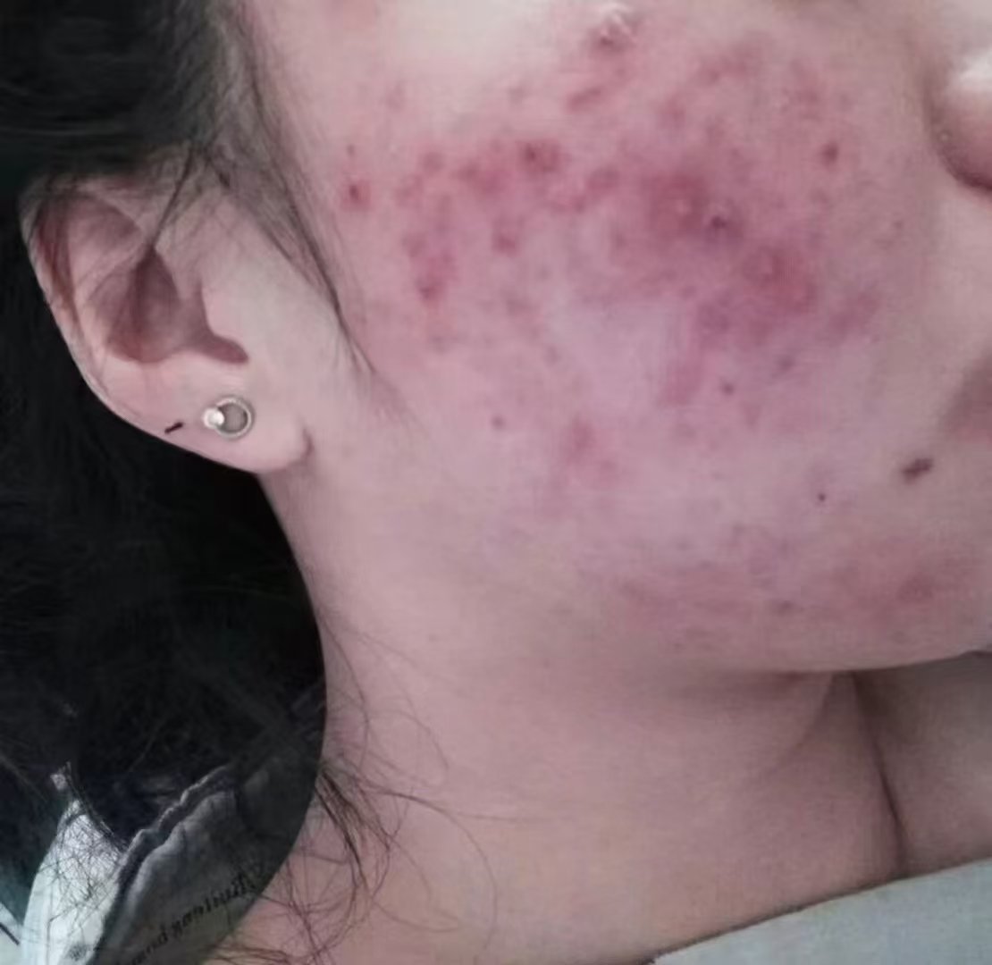 痘痘脸(痘痘脸可以用肥皂洗脸吗)