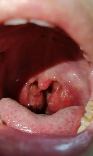 喉咙里一粒一粒像痘痘一样(喉咙里一粒一粒像痘痘一样怎么消除)