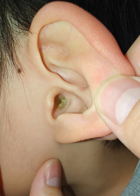 耳朵长痘痘怎么回事(耳朵感染hpv图片)