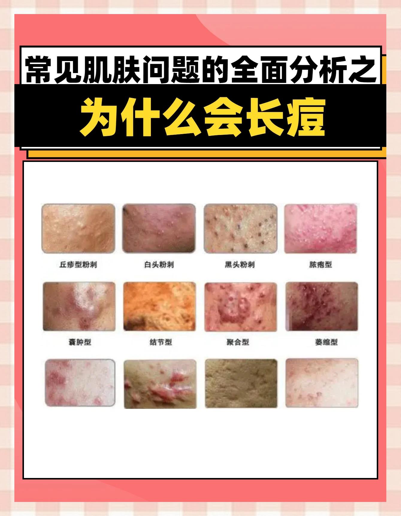 长痘痘是什么原因(私处长痘痘是什么原因)