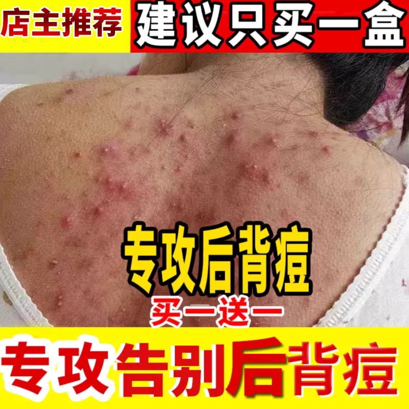 背上长痘痘擦什么药膏(后背长痘痘怎么消除最快最有效)