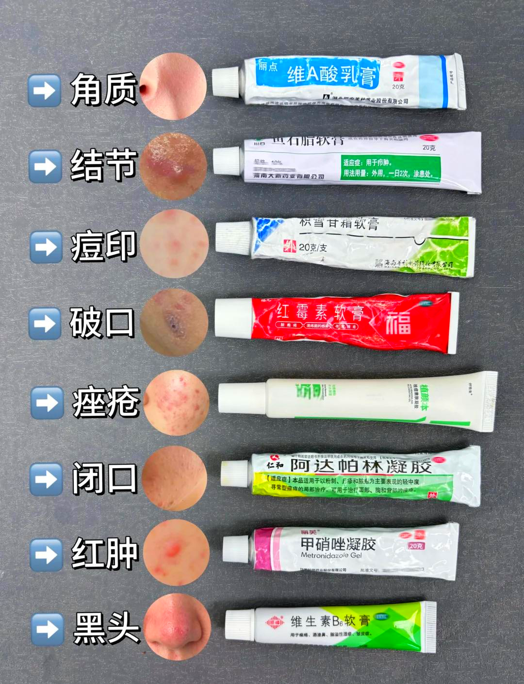 背上长痘痘擦什么药膏(后背长痘痘怎么消除最快最有效)