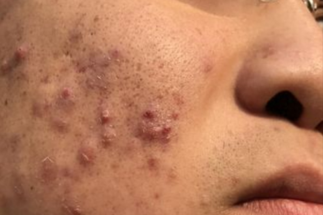 脸上起痘痘(脸上起痘痘去医院挂什么科)