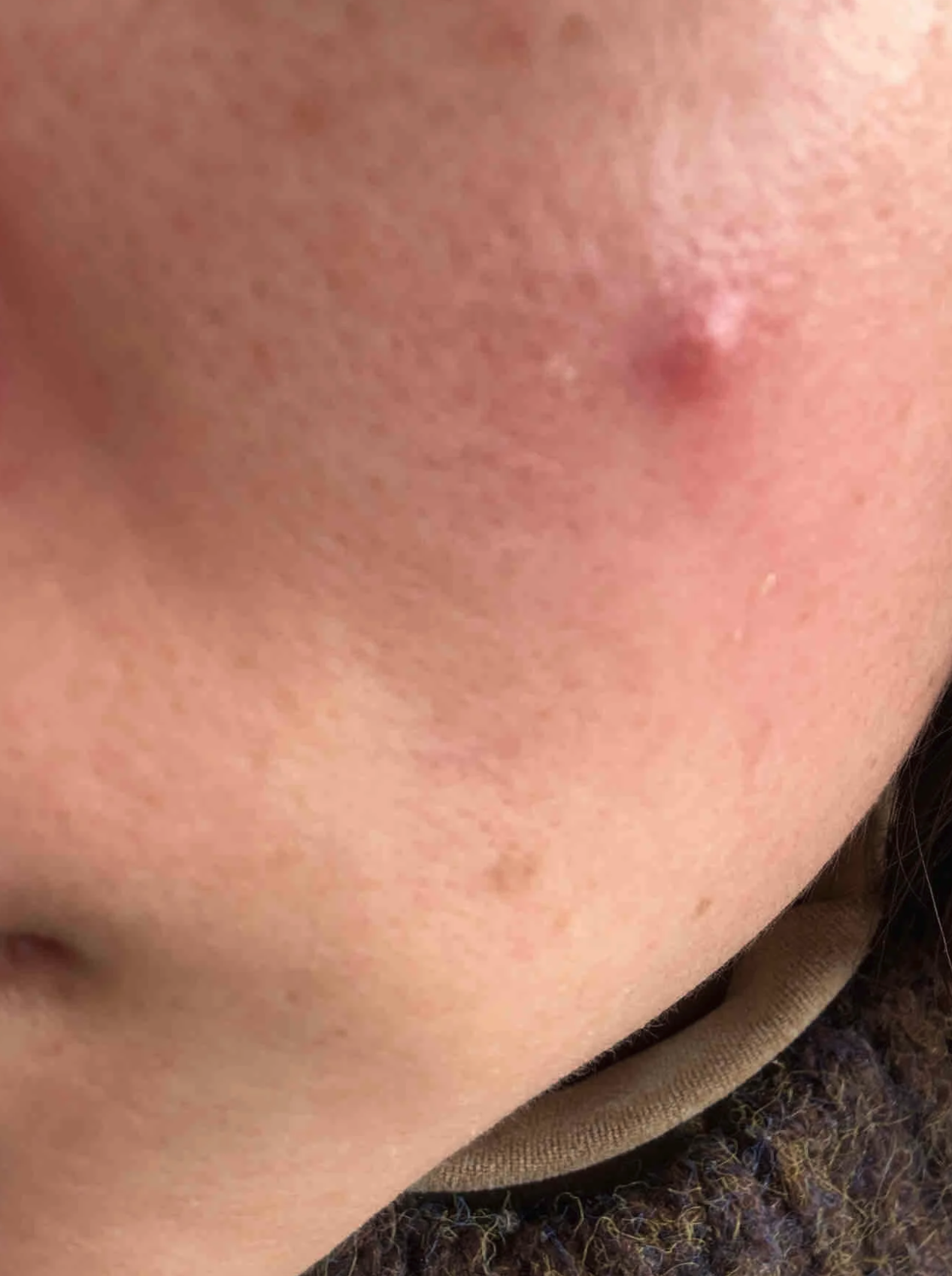 脸上起痘痘(脸上起痘痘去医院挂什么科)