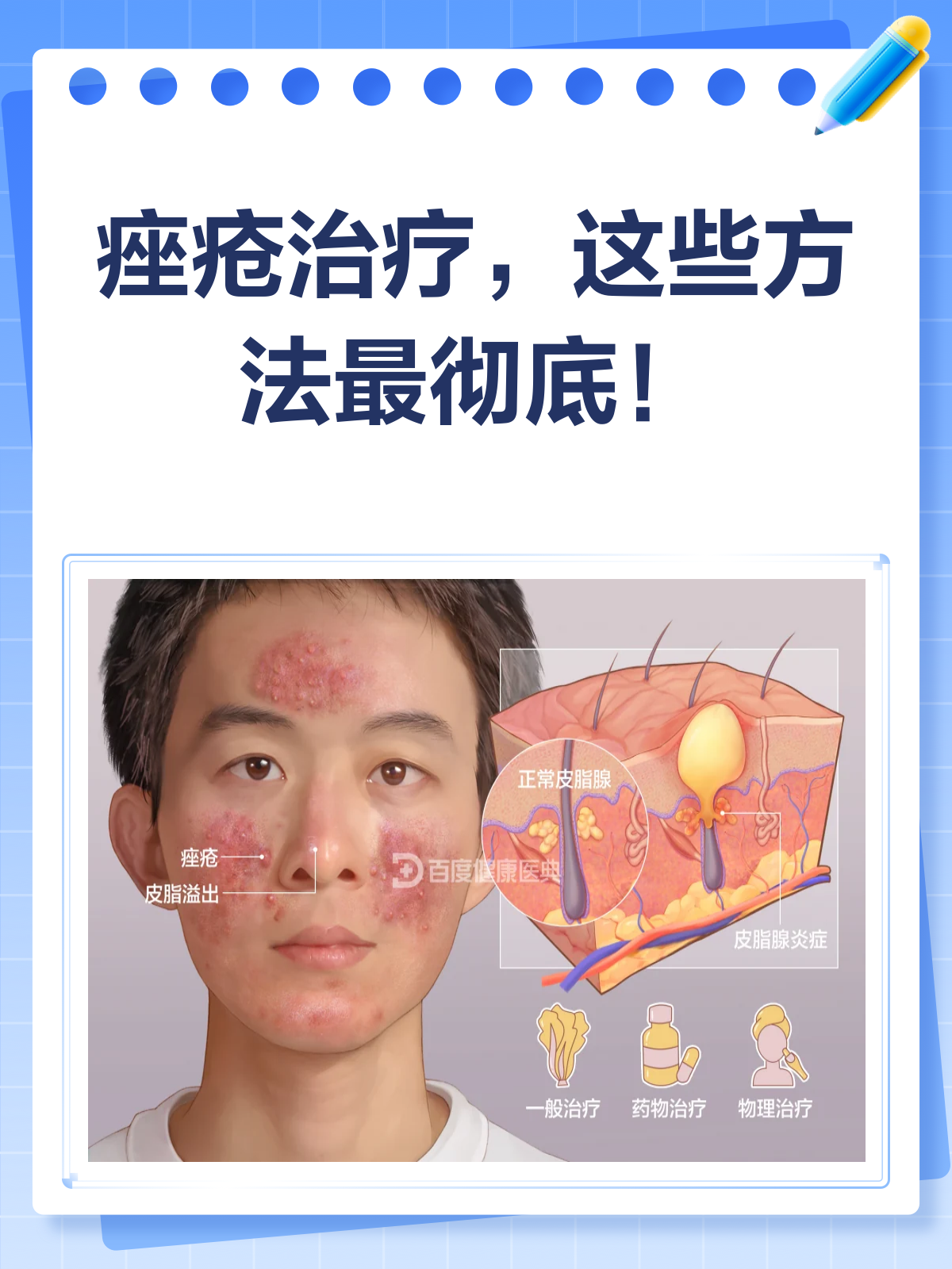 痘痘治疗(痘痘治疗药物)