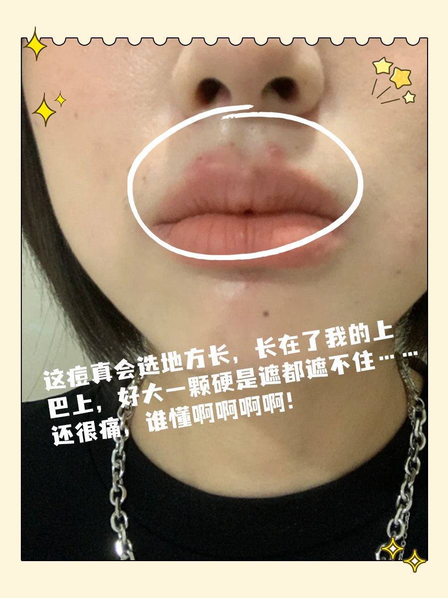 人中长痘痘是什么原因(人中反复长痘痘是什么原因)