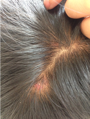 头上长痘痘(头上长痘痘用什么药)