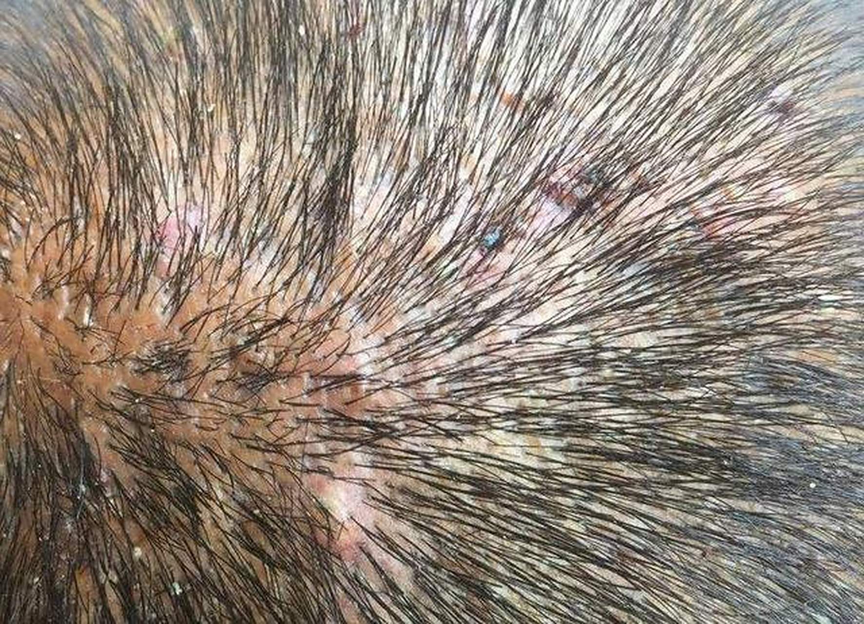 头上长痘痘(头上长痘痘用什么药)