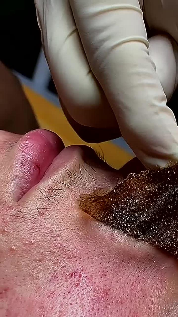 挤痘痘视频(挤痘痘视频最新)