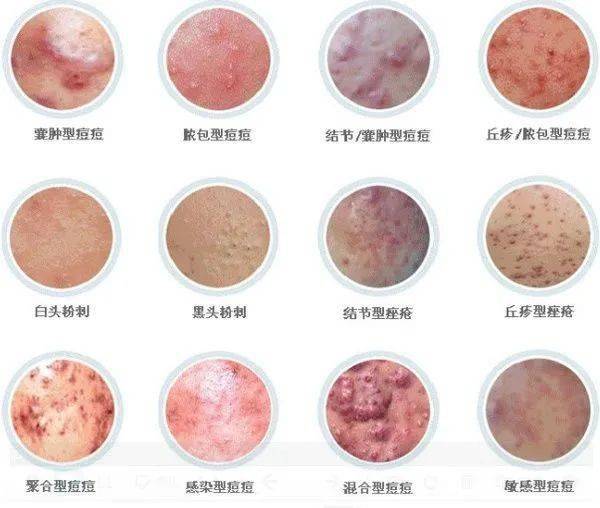 外阴上长了个痘痘(女士阴外部长痘痘)