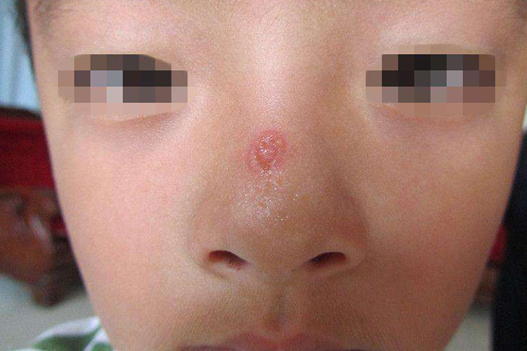 鼻子上长脓包型痘痘怎么办(12岁女孩鼻子上长脓包型痘痘怎么办)