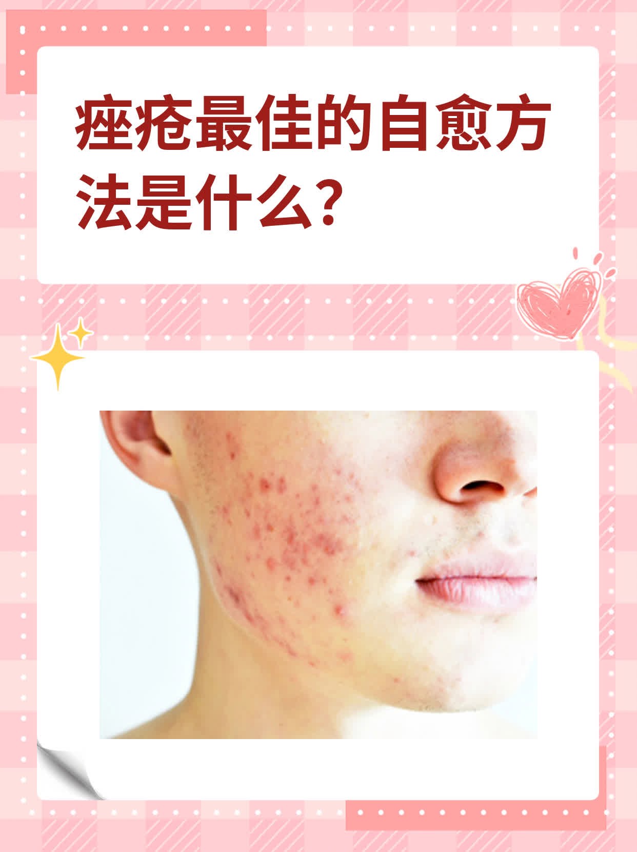 治痘痘(治痘痘什么药最快最好的方法)