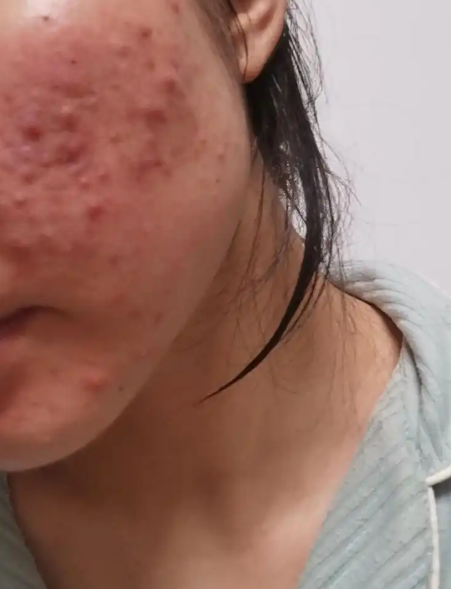 无脓头很大很硬的痘痘(无脓头很大很硬的痘痘可以用红霉素吗)