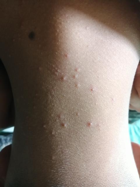 脖子上长了很多小痘痘(脖子上长了很多小痘痘是什么原因)