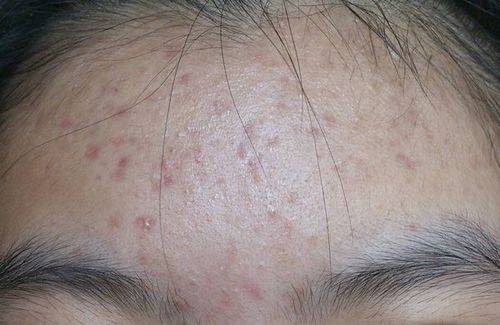 内分泌失调长痘痘(内分泌失调长痘痘吃什么药)