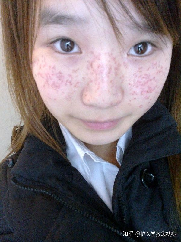 内分泌失调长痘痘(内分泌失调长痘痘吃什么药)