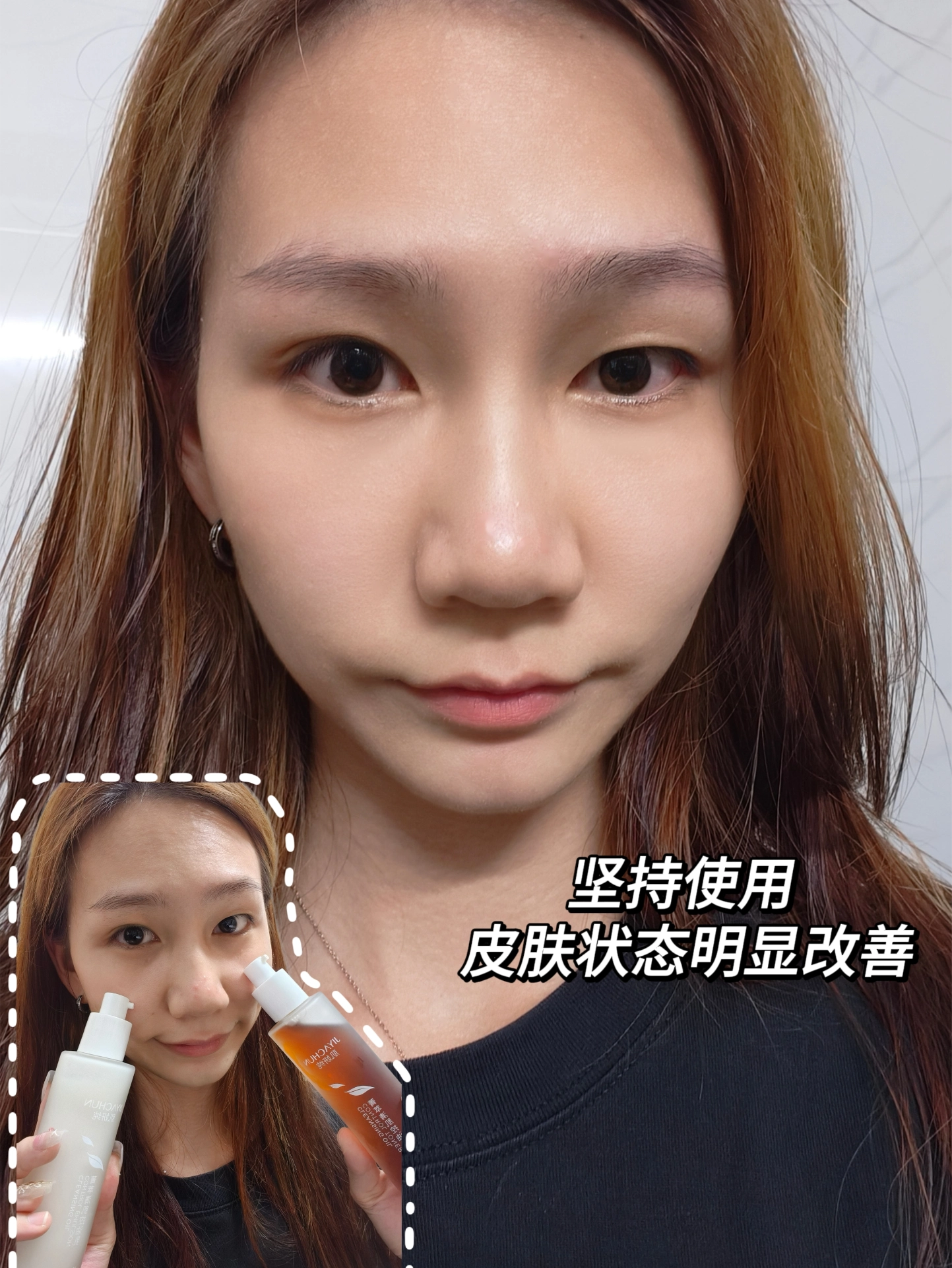 痘痘会自己消失吗(不挤痘痘会自己消失吗)