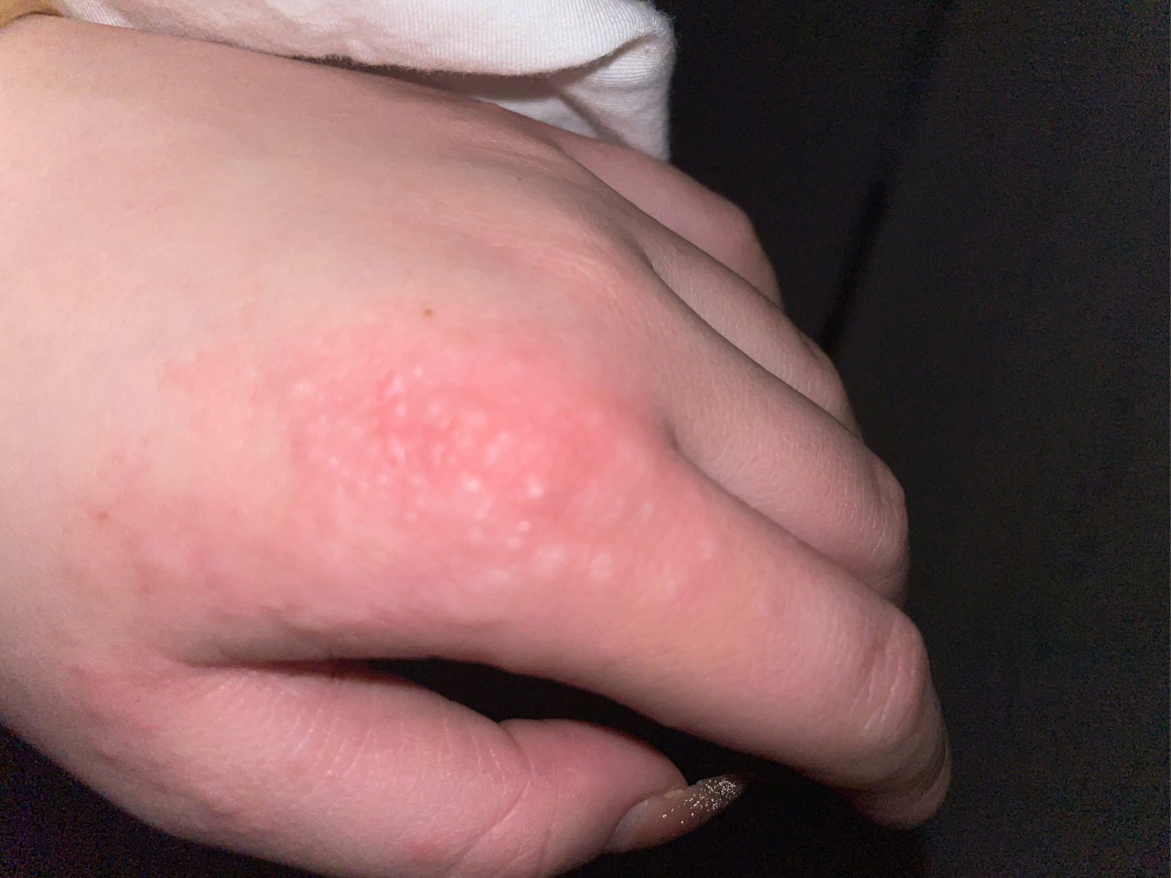 手上长痘痘(手上长痘痘图片)