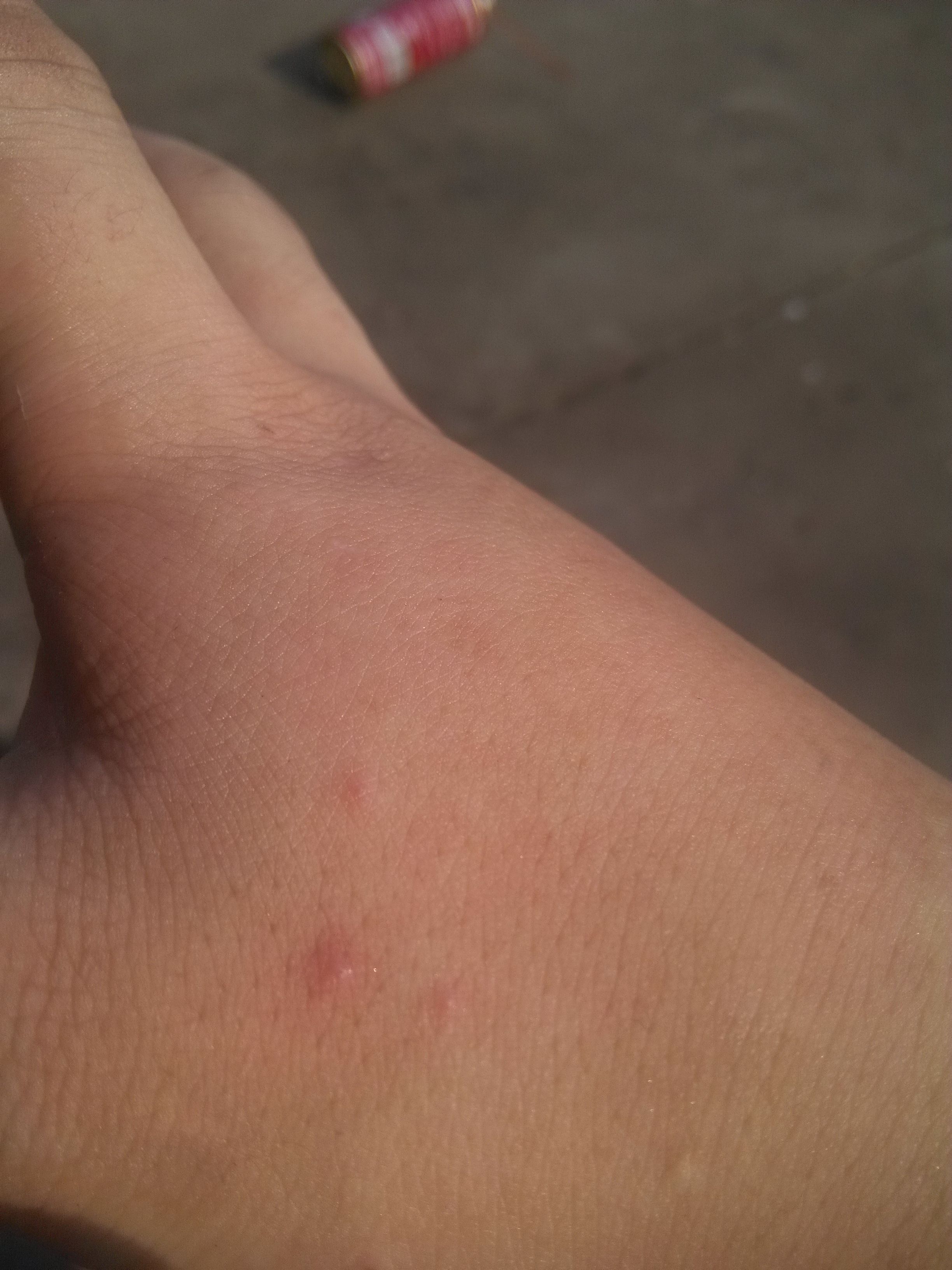 手上长痘痘(手上长痘痘图片)