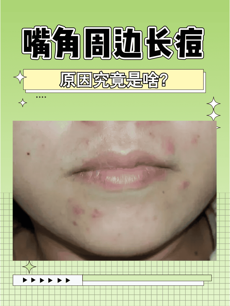 眉心长痘痘什么原因(眉毛长痘痘什么原因引起的)