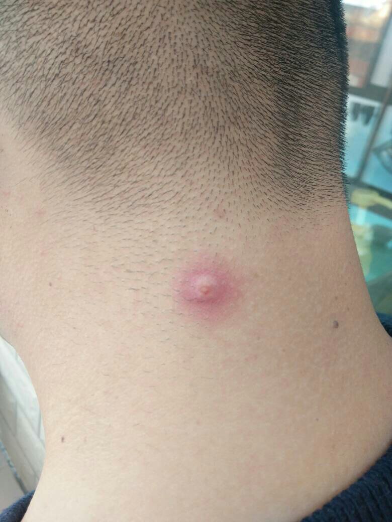 脖子上长痘痘(脖子上长痘痘用什么药膏最好)