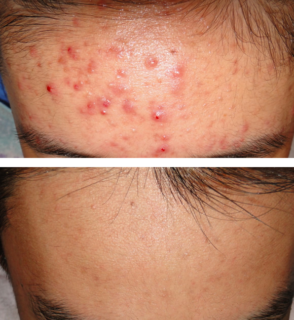 额头长痘痘(额头长痘痘怎么才能消除)