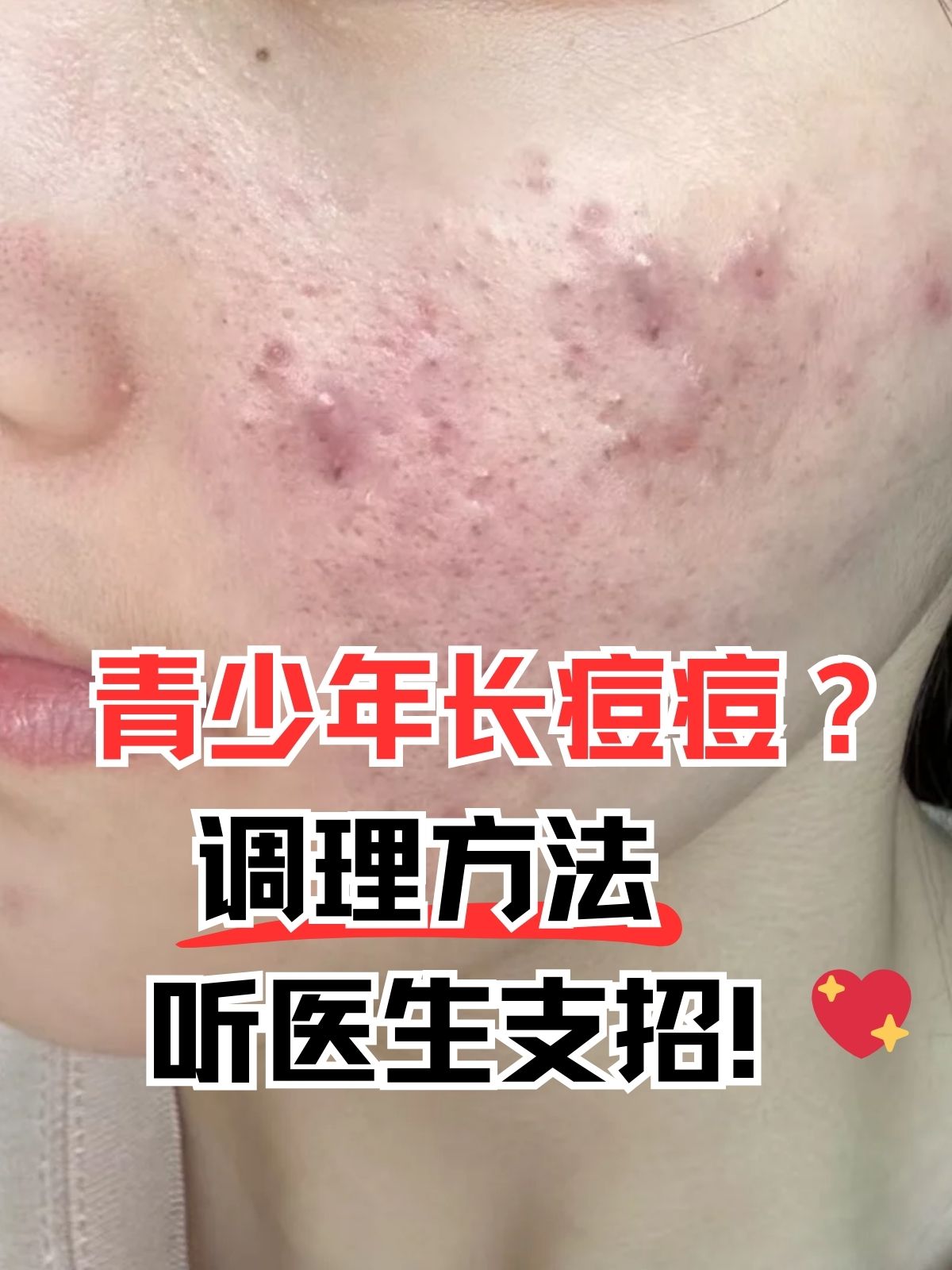 中医看痘痘效果好吗(内分泌失调长痘图片)