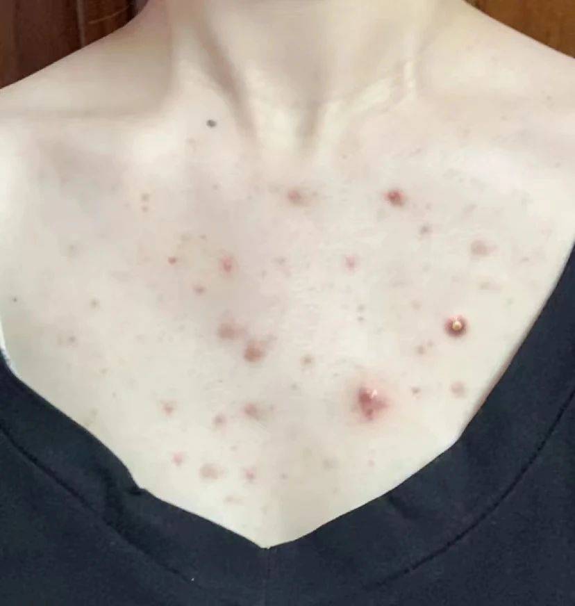 前胸后背长痘痘是什么原因(男孩子前胸后背长痘痘是什么原因)